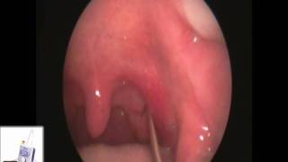 Tonsil Stone Extraction with Laser Cryptolysis [upl. by Ahaelam682]