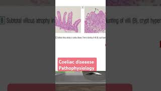 Coeliac diseaese pathophysiology شرح بالعربي [upl. by Colt]