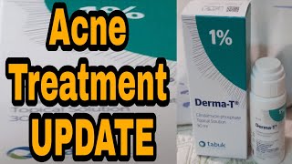 Acne Treatment Using Clindamycin phosphate Topical Solution  Update after 1 month of treatment [upl. by Ilsa]