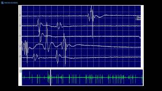 Kimura amp Kohara F32 Typical fasciculation potentials [upl. by Hui]