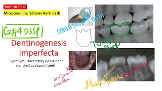 Dentinogenesis Imperfecta  Type 1 and 2 High yield points with diagramsNEET MDS  INICET  INBDE [upl. by Margareta407]