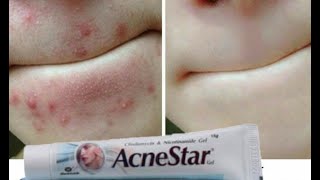 AcneStar Gel Remove Acne  Pimples  BlackheadsComplete Review हिन्दी मैं [upl. by Yerot745]