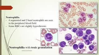 Practical Hematology 11 Morphology of Benign WBCs disorders [upl. by Demakis]