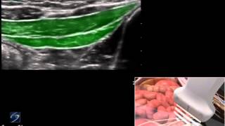 3D How To Ultrasound Guided Ilioinguinal and Iliohypogastric Nerve Block  SonoSite Ultrasound [upl. by Charlotte474]