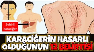 12 Belirti Karaciğerinizde Sorun Olduğunu Gösterir [upl. by Hillary]