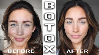 BOTOX TREATMENT BEFORE amp AFTER [upl. by Nnaeirelav356]