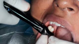 infected molar with periapical cyst extraction [upl. by Tipton]