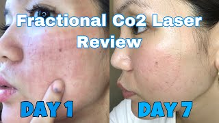 FRACTIONAL CO2 LASER AFTER TREATMENT REVIEW  DAY 1 TO DAY 7  VLOG 5 [upl. by Lolly548]