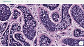 Cylindroma  Histopathology [upl. by Auqkinahs]