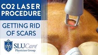 CO2 Laser Resurfacing Treatment For Getting Rid of Scars  Full Procedure [upl. by Eixam]