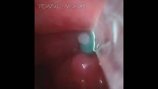 Tonsil stones removal haul at the end [upl. by Naivaj]