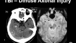 Diagnosing Brain Hemorrhages [upl. by Whitelaw903]