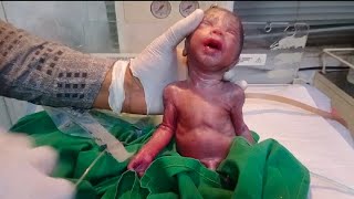 Premature low birth weight baby came weight is just 2 lbs plz pray for baby critical baby suction [upl. by Kalie]