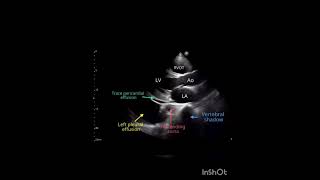 2d echo cardiology heart medicos medicine⛑️🏥🏥🩺🩺🩺🩺⛑️⛑️⛑️⛑️⛑️ Sudarshanlipane17 [upl. by Helli]