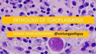 Pathology of toxoplasmosis [upl. by Zampino]