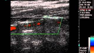 ECHO DOPPLER VERTEBRAL ARTERY FLOWwmv [upl. by Nesyaj385]