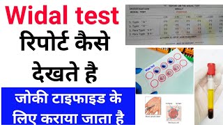 Widal test रिपोर्ट कैसे देखते है  Typhoid Test कैसे किया जाता है [upl. by Suiraj520]