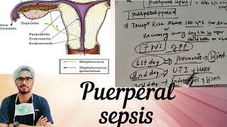 Puerperal sepsis part 1 [upl. by Sirah]