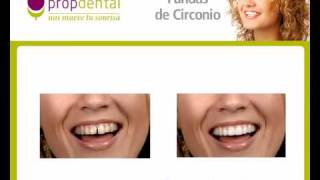 Zirconio  Protesis de circonio  Dientes 100 naturales [upl. by Ludovico795]