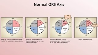 Intro to EKG Interpretation  Rate and Axis [upl. by Zoldi]