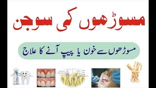 Masooron ki sujan ka ilaj  Pyorrhea treatment at home Urdu  Pyorrhoea ka gharelu ilaj [upl. by Conners505]