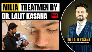 How To Remove Milia Permanently II MILIA TREATMENT BY Dr Lalit Kasanas [upl. by Shishko]