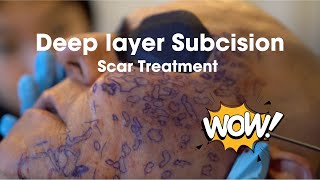 Deep Layer Subcision Scar Treatment [upl. by Gwynne268]