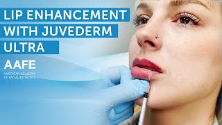 Adding More Lip Volume with Juvederm Ultra  AAFE [upl. by Karney13]