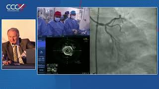 Live Case 5  IVUS Guided Distal Left Main PCI with Crossover Stenting [upl. by Aloap]