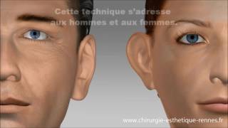 Technique earfold Oreilles décollées par le Dr Delliere [upl. by Jago]