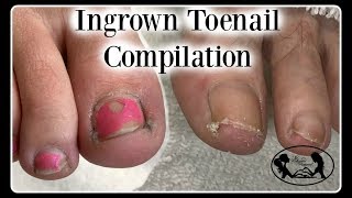 Satisfying Ingrown Toenail Pedicure Compilation [upl. by Hussein373]