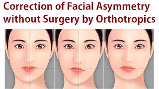 Correction of Facial Asymmetry Without Oral Surgery Using Orthotropics Method By Dr Mike Mew [upl. by Anivlis702]