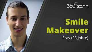 Veneers vorher nachher Zahnkorrektur mit Veneers  Smile Makeover von Eray bei 360°zahn [upl. by Ttehr]