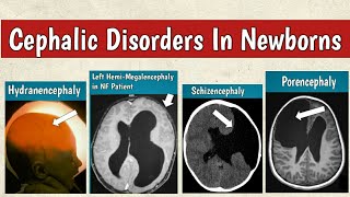 Cephalic Disorders In Newborns  Congenital Brain Malformations Radiology [upl. by Zackariah98]