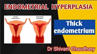 Endometrial hyperplasia  Thick endometrium heavybleeding uterus [upl. by Yeliac]