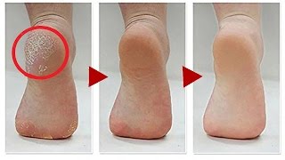 How to Get Rid Of Calluses On Feet  6 Natural Home Remedies to get rid of calluses on feet [upl. by Arbed]