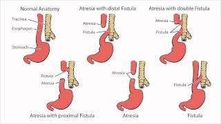 Esophageal Atresia  What is Esophageal Atresia [upl. by Hafeetal]