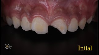 Class IV restorations using layering technique  trauma of central incisors for a boy [upl. by Adnac376]