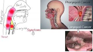 Throat cancer  Symptoms causes and Treatment Laryngeal Cancer and Pharyngeal Cancer [upl. by Haelem150]