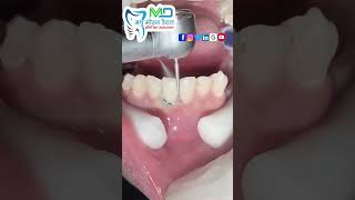 Teeth Composite filling [upl. by Augy]