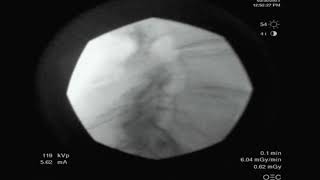 Fluoroscopic lumbar epidural injection lateral contrast spread [upl. by Aynom99]