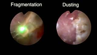 fURS Dusting vs Fragmentation Holmium laser lithotripsy [upl. by Enyrat727]