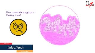 Verrucous carcinoma Histopathological features lets draw [upl. by Nivlad]