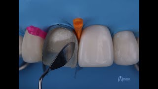 direct composite veneers with layering technique [upl. by Fitting]