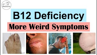 Vitamin B12 Deficiency Weird Symptoms – Part 2 Types of Headaches Gastrointestinal and Others [upl. by Mossberg]