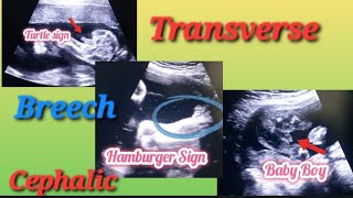 Transverse Breech amp Cephalic Baby In Uterus Genderreveal  Anterior Posterior Placenta Baby Gender [upl. by Ainirtak526]