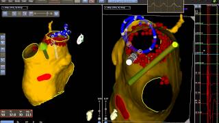 Ablazione della fibrillazione atriale con CARTO 3 [upl. by Alit]