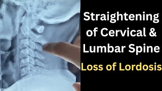 Straightening of Cervical Curvature Loss Of Lumbar lordosis Lumbar curvature Straightening in Xray [upl. by Nnylimaj374]