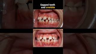 Braces for gapped teeth and overbite braces orthodontist bracesoff dentist [upl. by Cara]