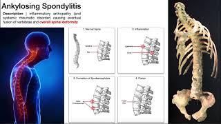 Ankylosing Spondylitis  Mechanism Risk Factors amp SignsSymptoms [upl. by Quince922]